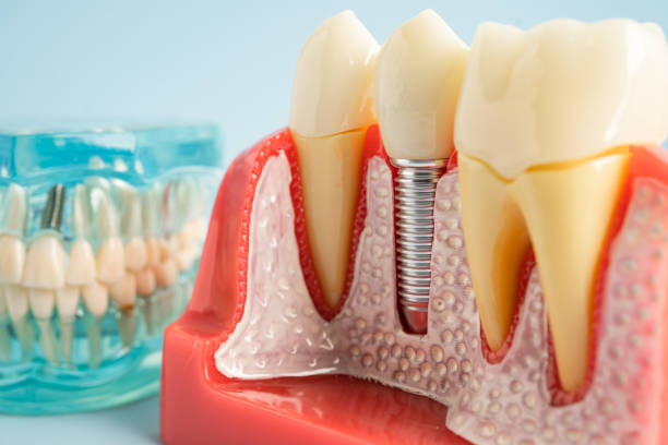 Best Root Canal Treatment  in Port Lavaca, TX